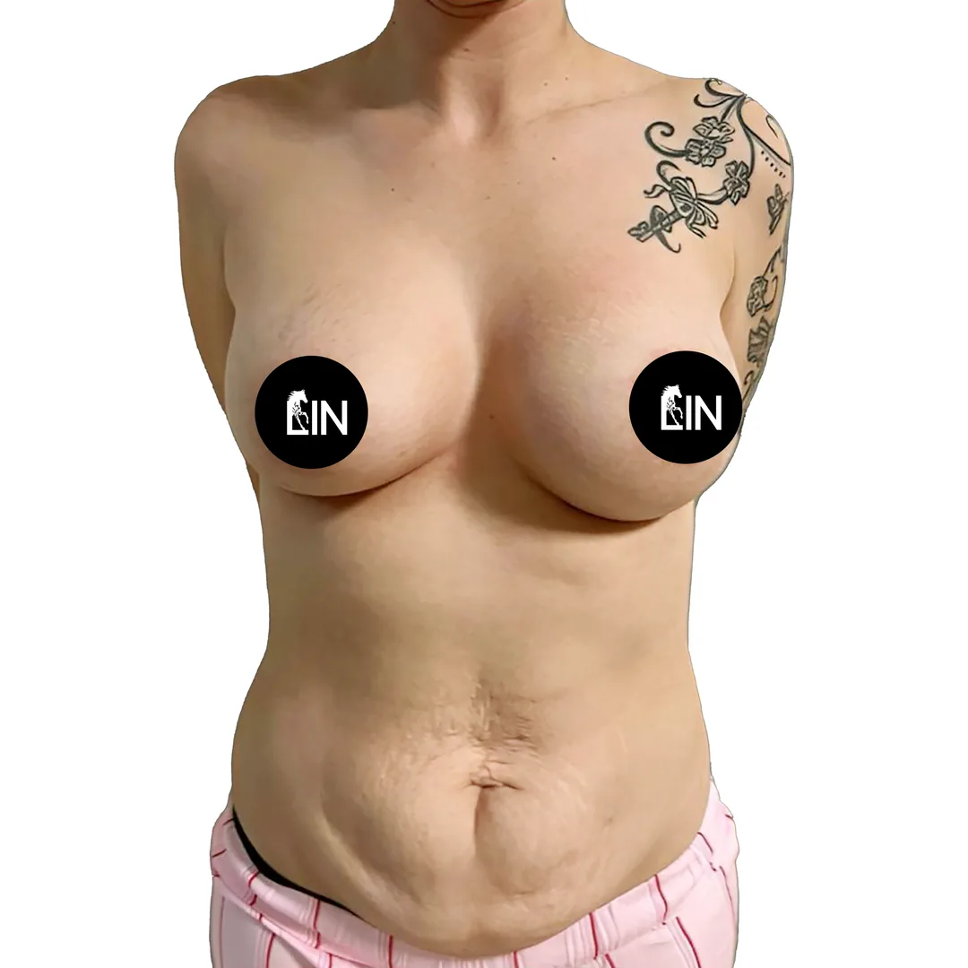 Liposuction · Front — До