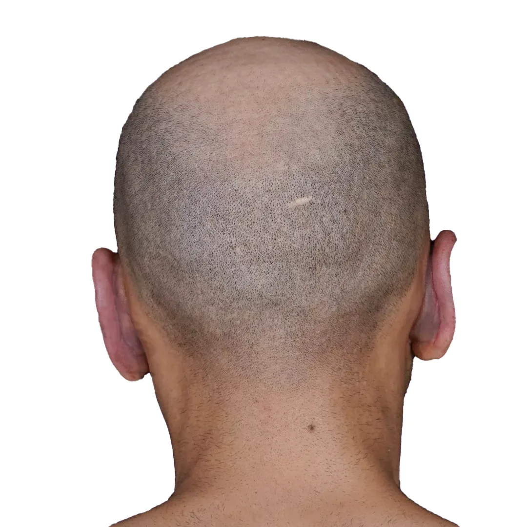Otoplasty — After