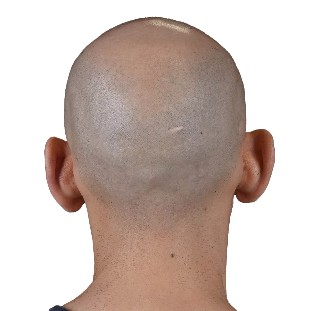 Otoplasty — Before