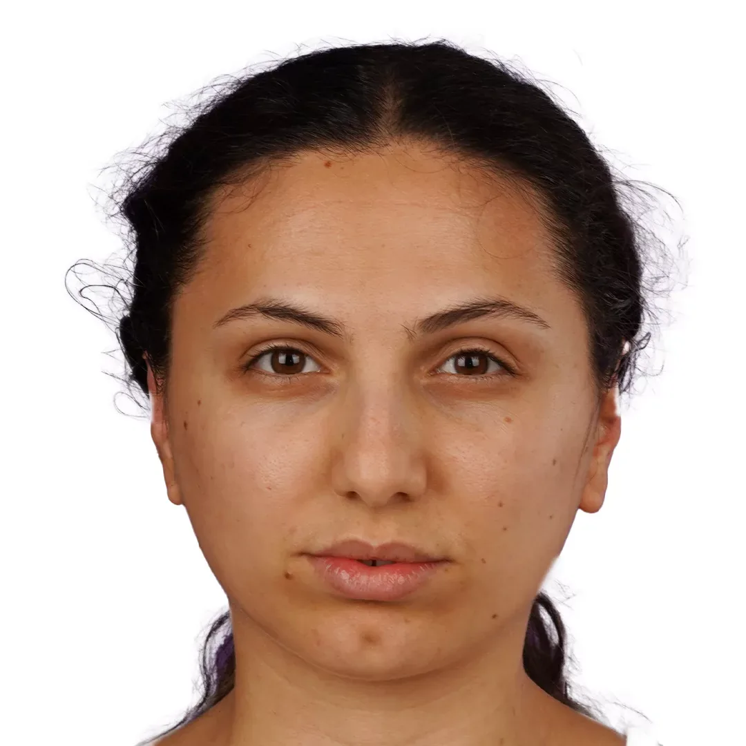 Otoplasty — After