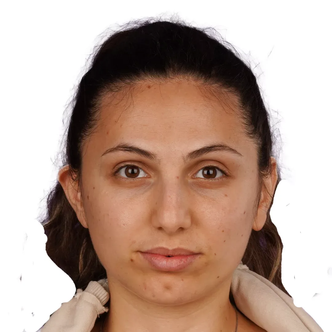 Otoplasty — Before