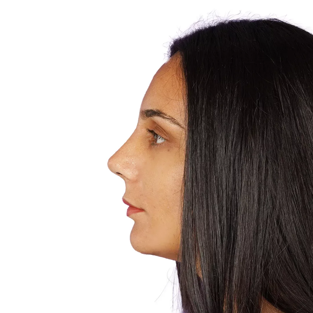 Rhinoplasty — After