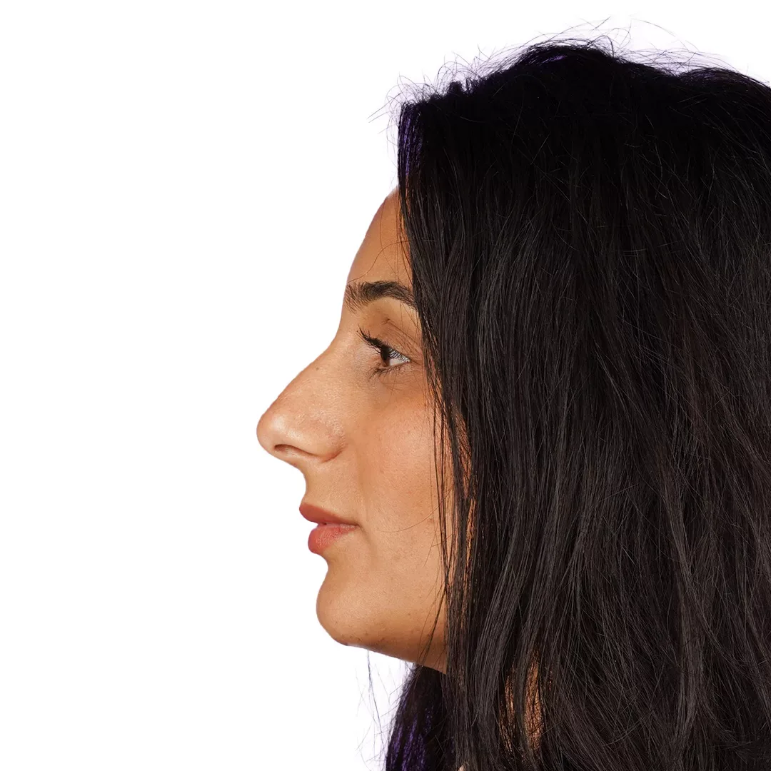 Rhinoplasty — Before