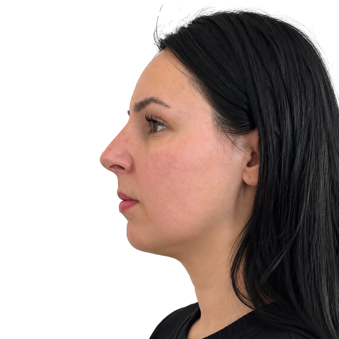 Rhinoplasty · Profile — Після