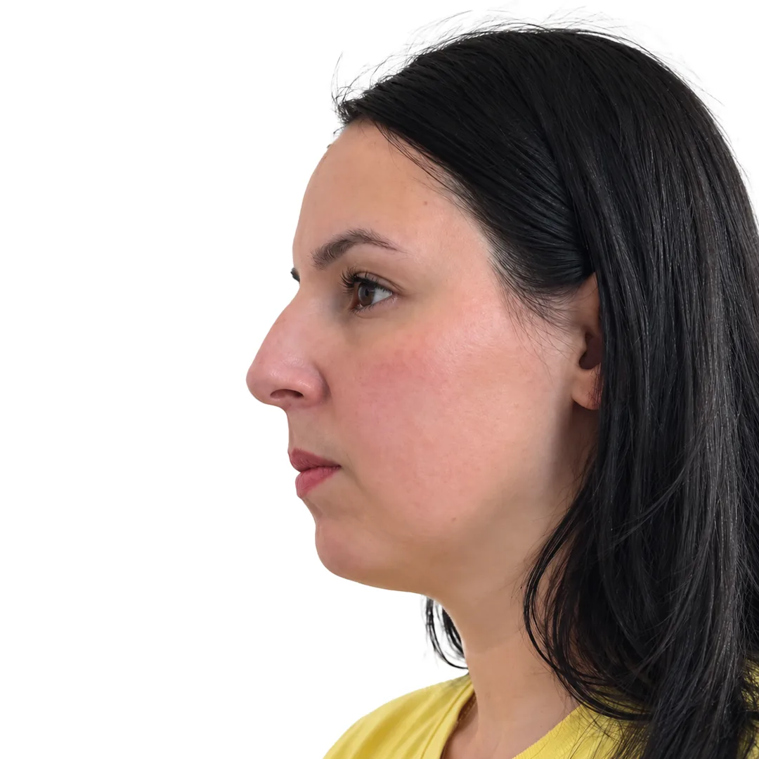 Rhinoplasty · Profile — До