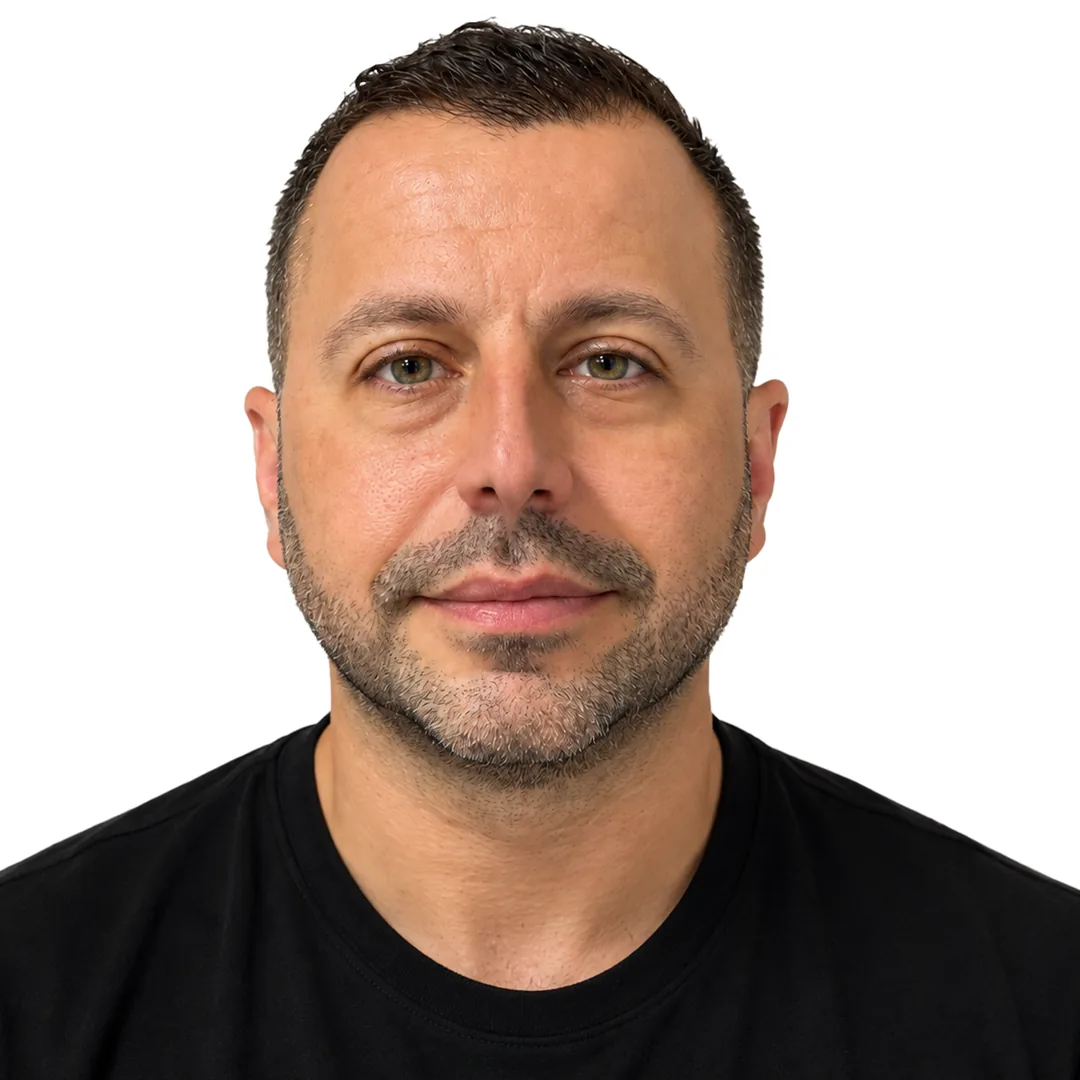 Rhinoplasty · Front — Після