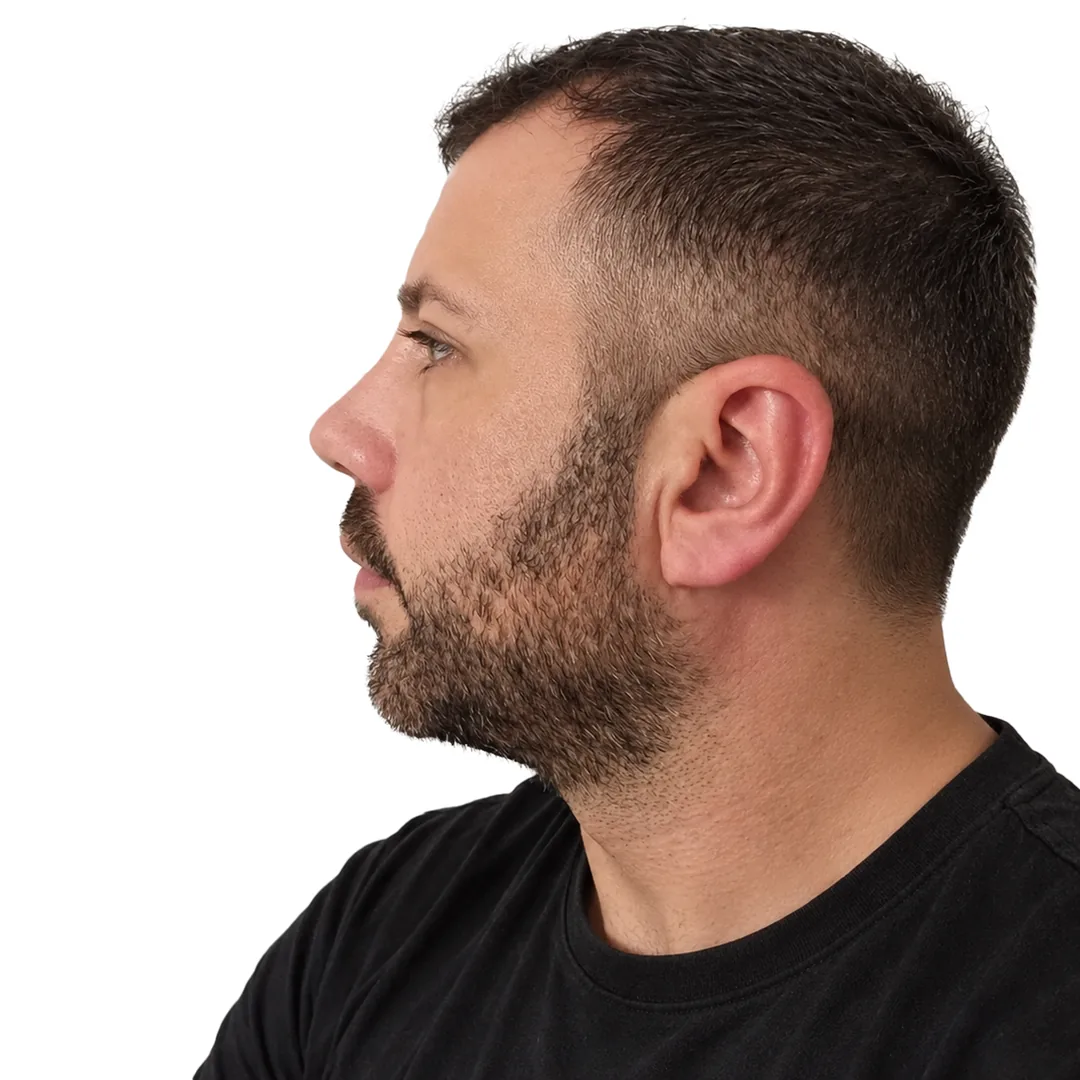 Rhinoplasty · Profile — Після