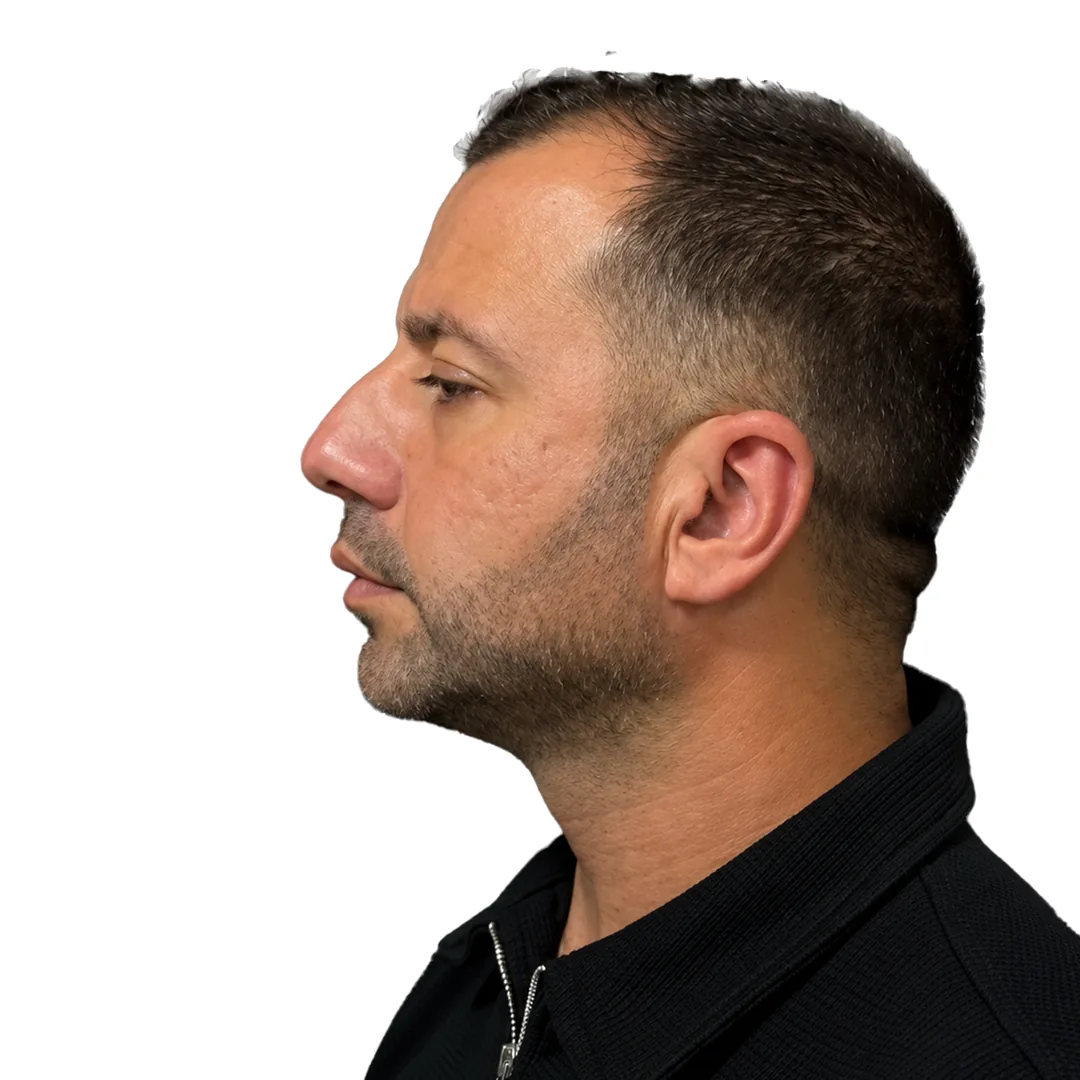 Rhinoplasty · Profile — До