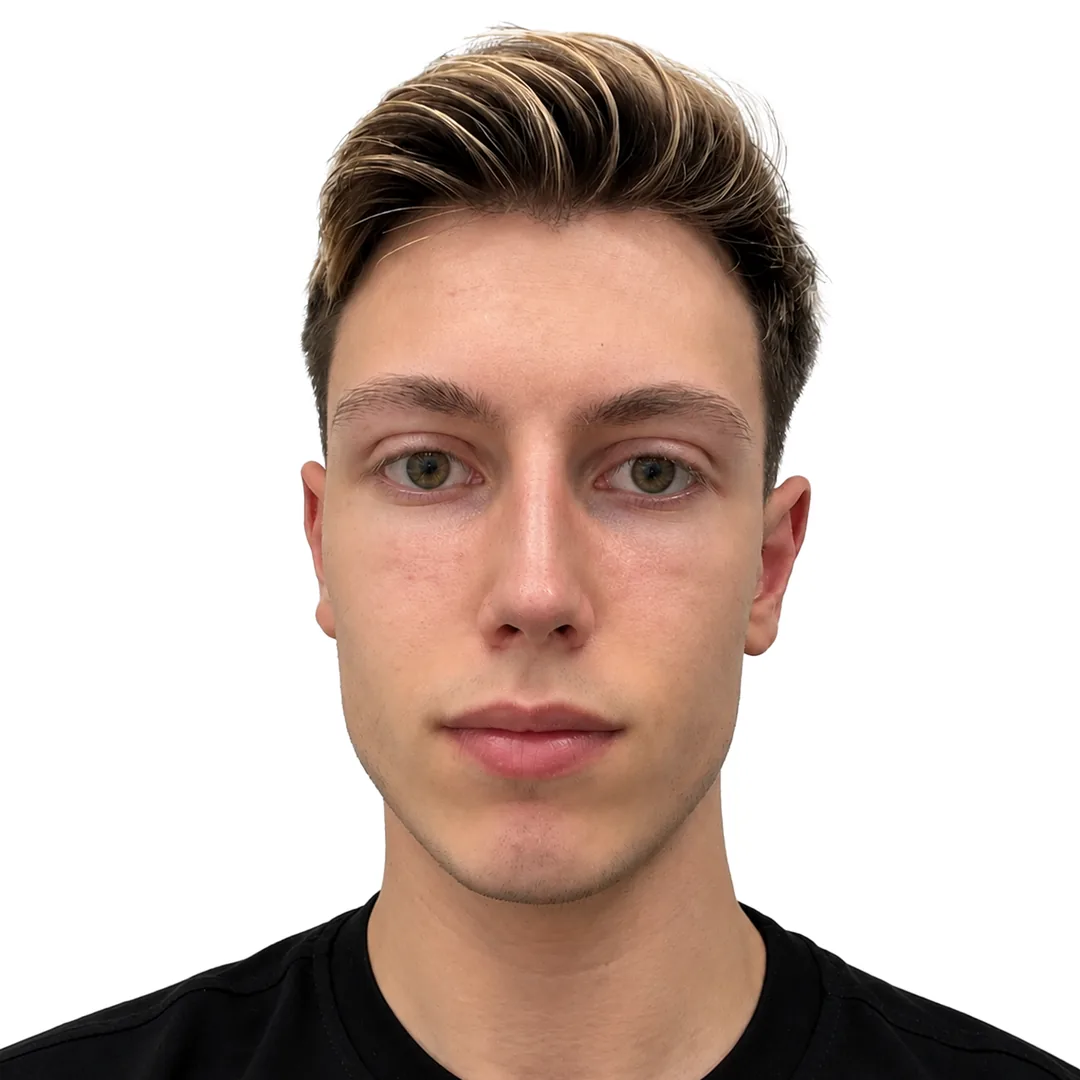 Rhinoplasty · Front — Після