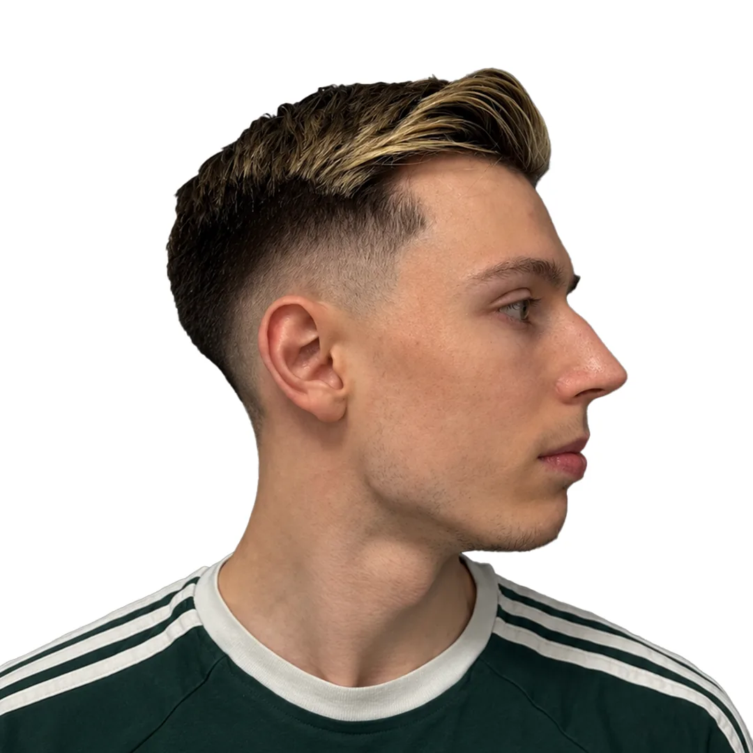 Rhinoplasty · Profile — До