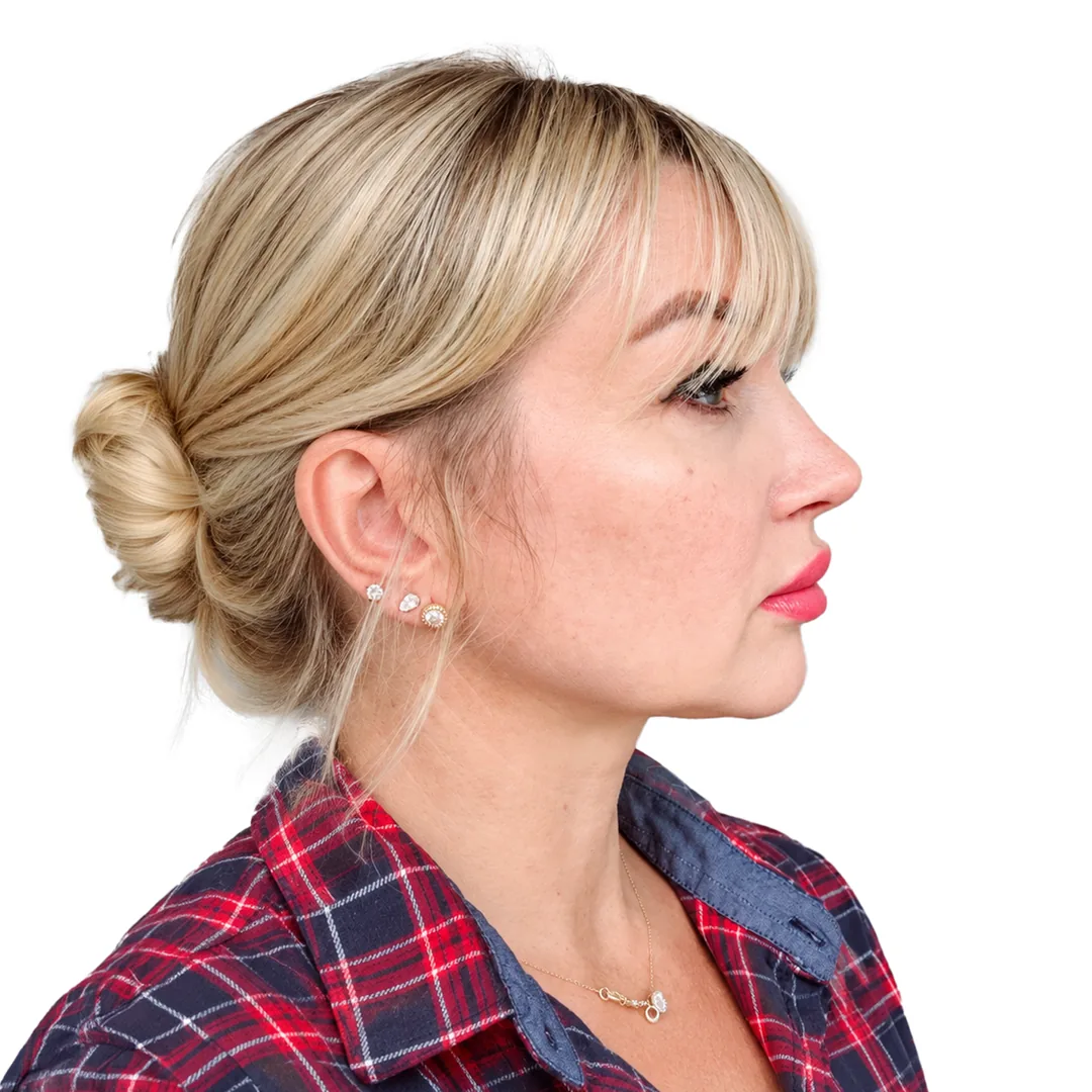 Rhinoplasty · Profile — Після