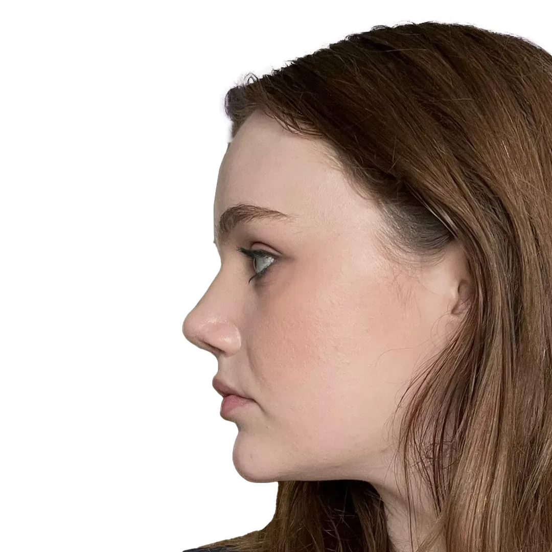 Rhinoplasty — After