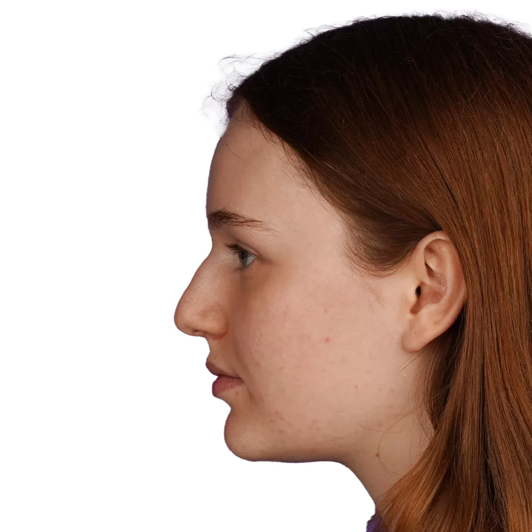 Rhinoplasty — Before