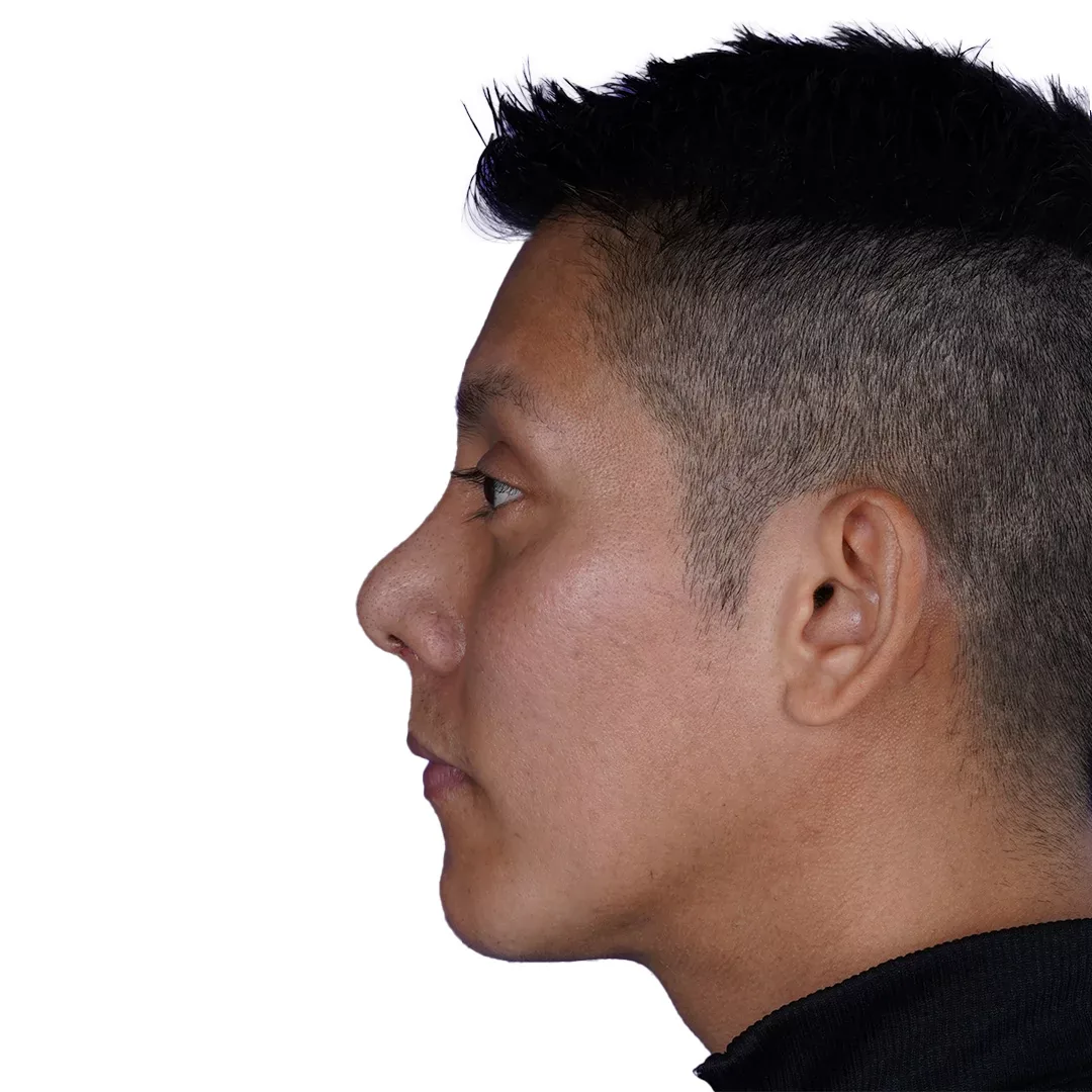 Rhinoplasty — After