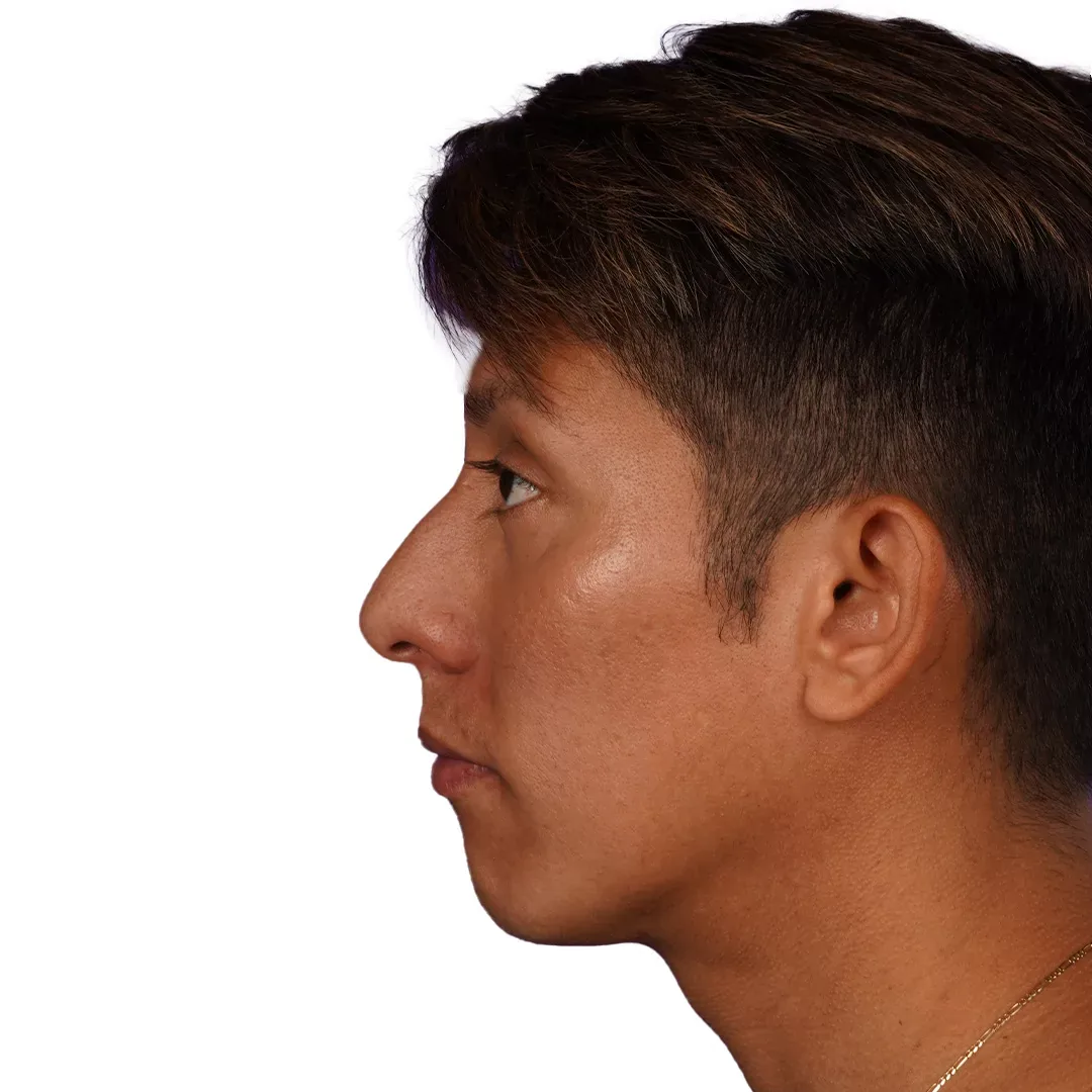 Rhinoplasty — Before
