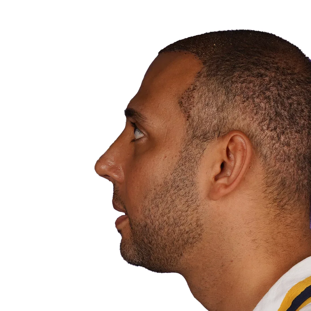 Rhinoplasty — After