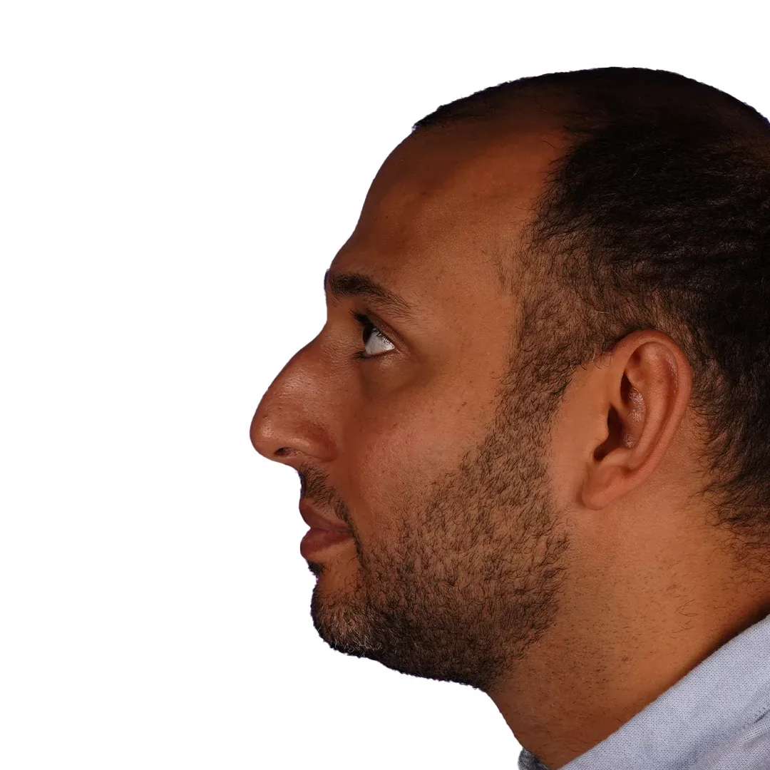 Rhinoplasty — Before