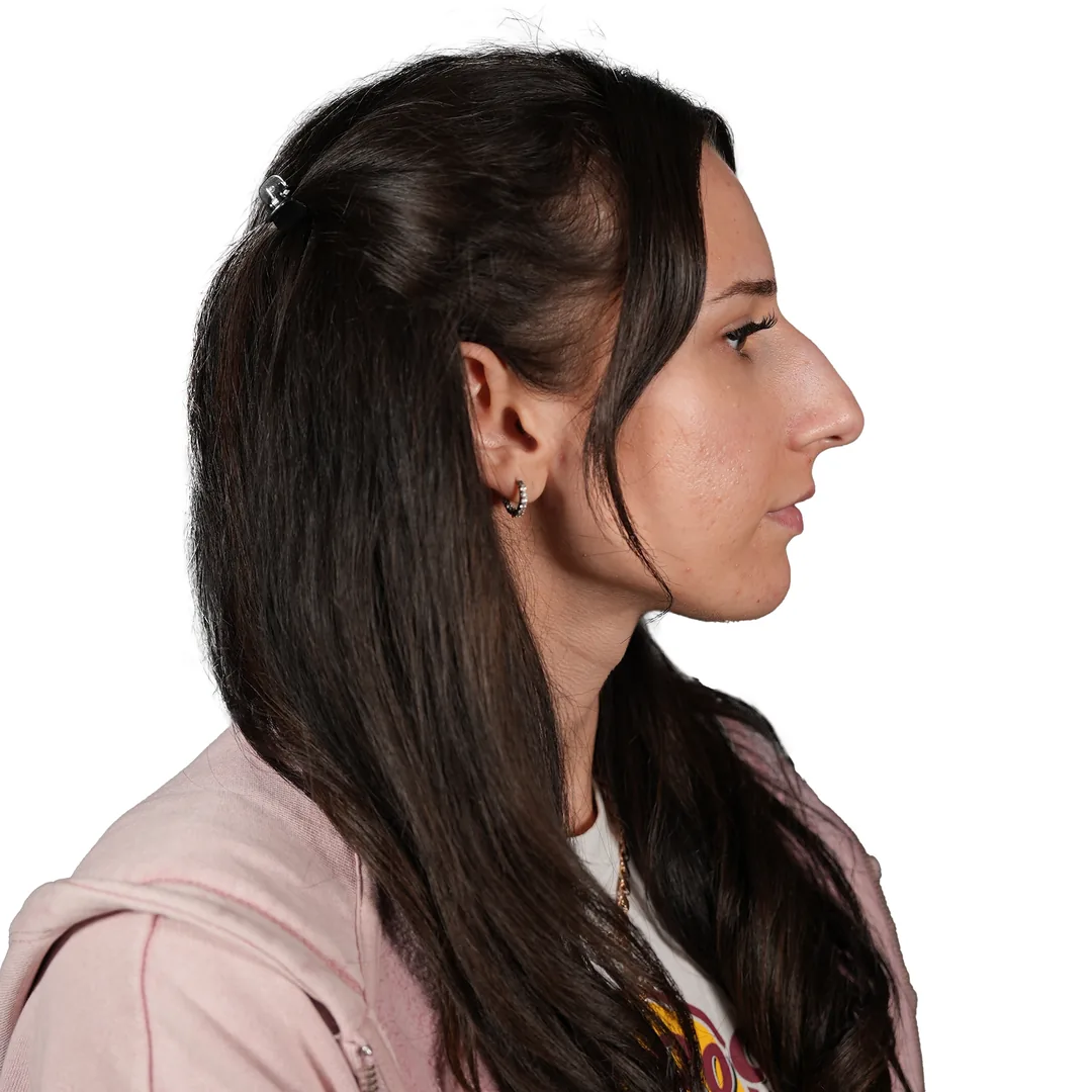Rhinoplasty · Profile — До