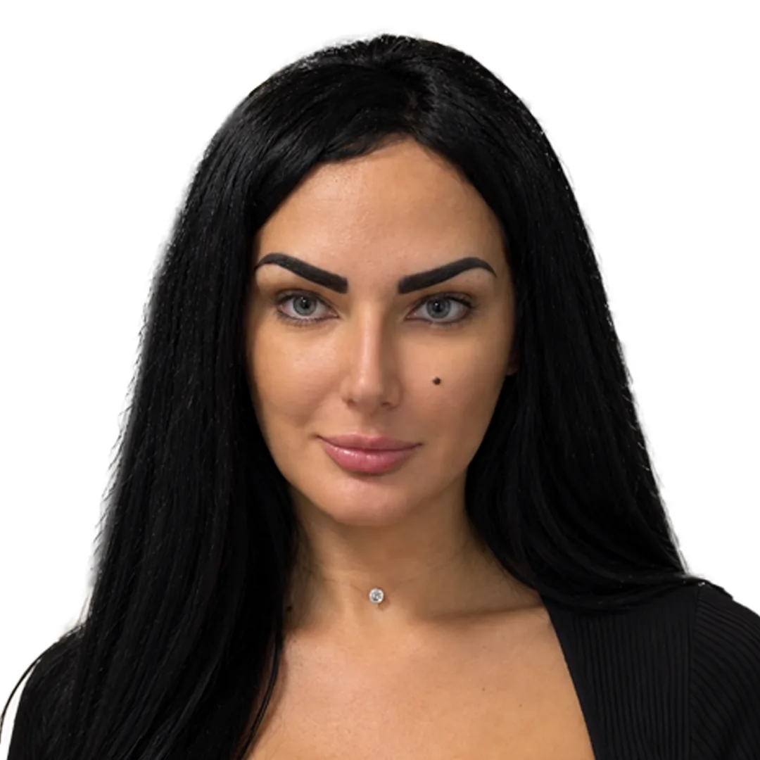 Rhinoplasty · Front — Після