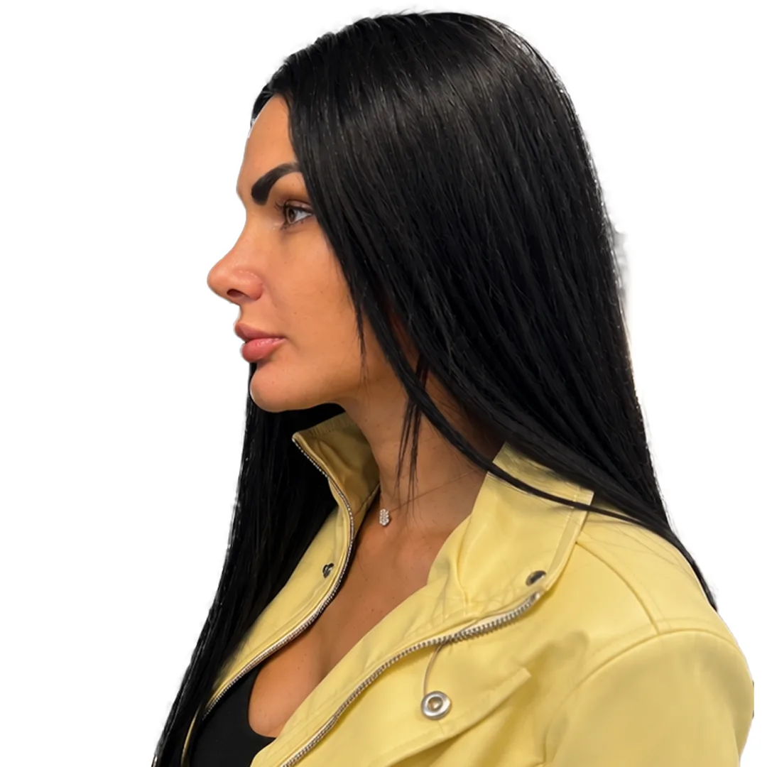 Rhinoplasty · Profile — Після