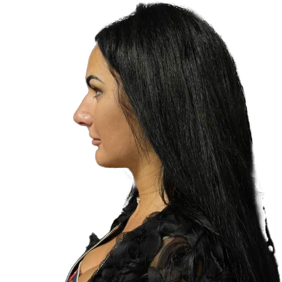Rhinoplasty · Profile — До