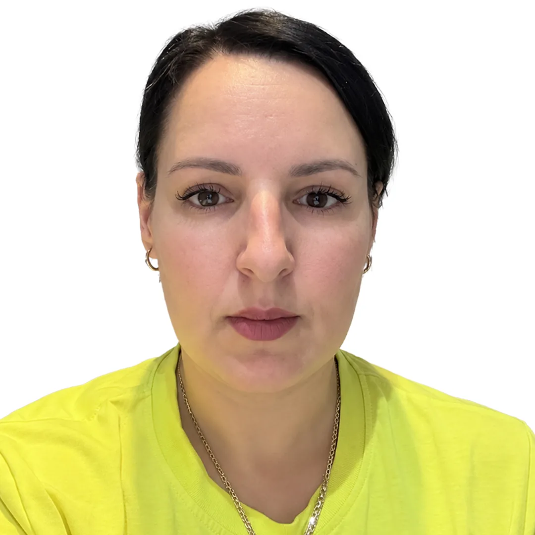 Rhinoplasty · Front — До