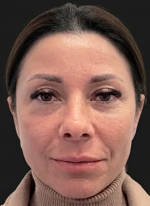 Skin · Hydration — Before