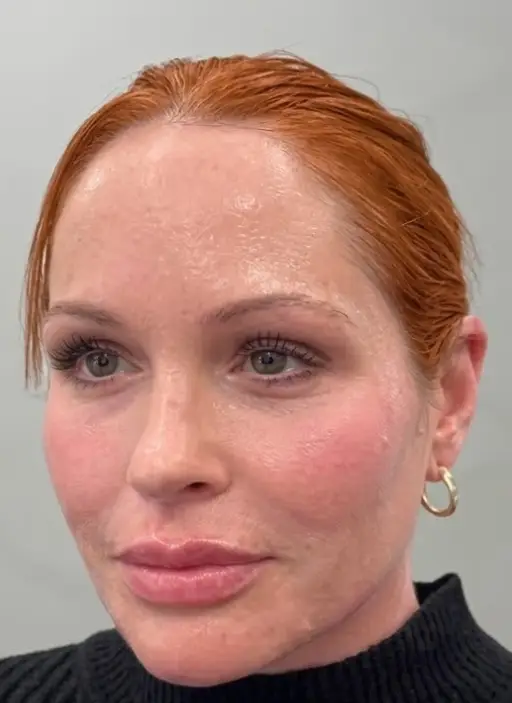 Skin · Even Tone — After
