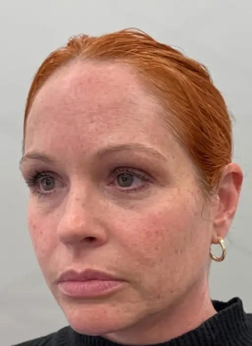 Skin · Even Tone — Before