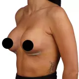 Breast Surgery