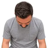 Hair Transplant · Crown