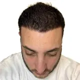 Hair Transplant