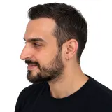 Hair Transplant · Three-quarter