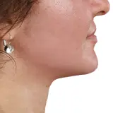 Jawline Contouring