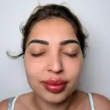 Lip Filler · Front