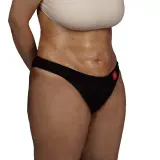 Liposuction