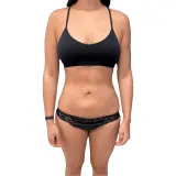 Liposuction · Front