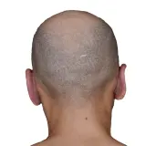 Otoplasty