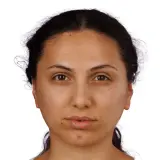 Otoplasty