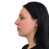 Rhinoplasty · Profile