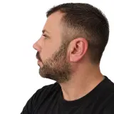 Rhinoplasty · Profile