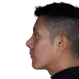 Rhinoplasty