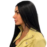 Rhinoplasty · Profile