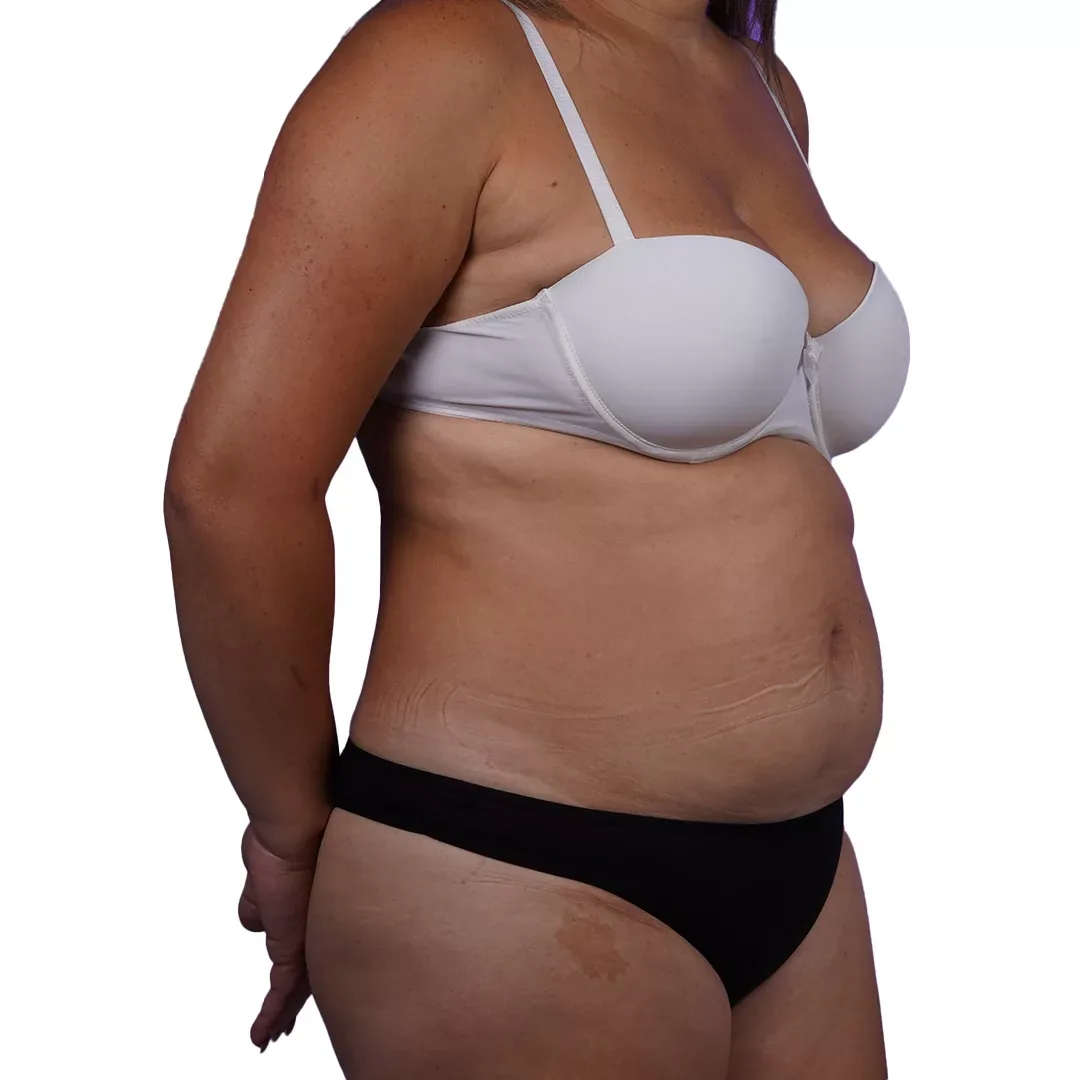 Tummy Tuck — Before