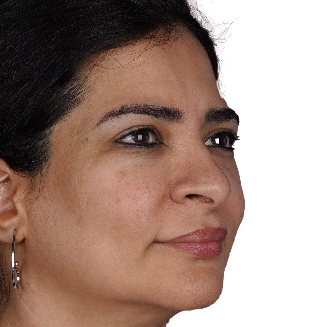 Ultherapy — Before