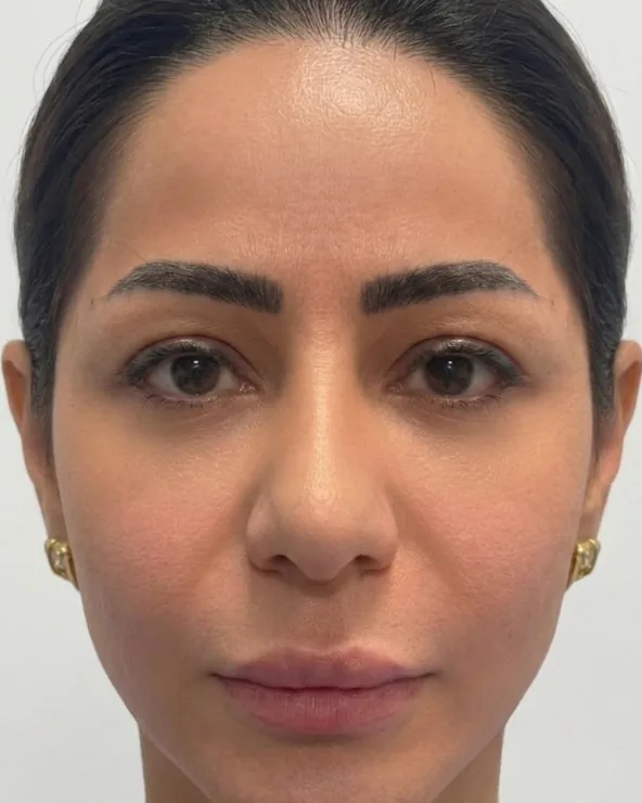 Under-Eye — After