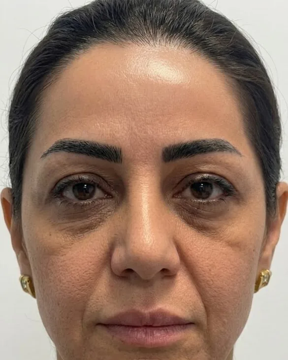 Under-Eye — Before