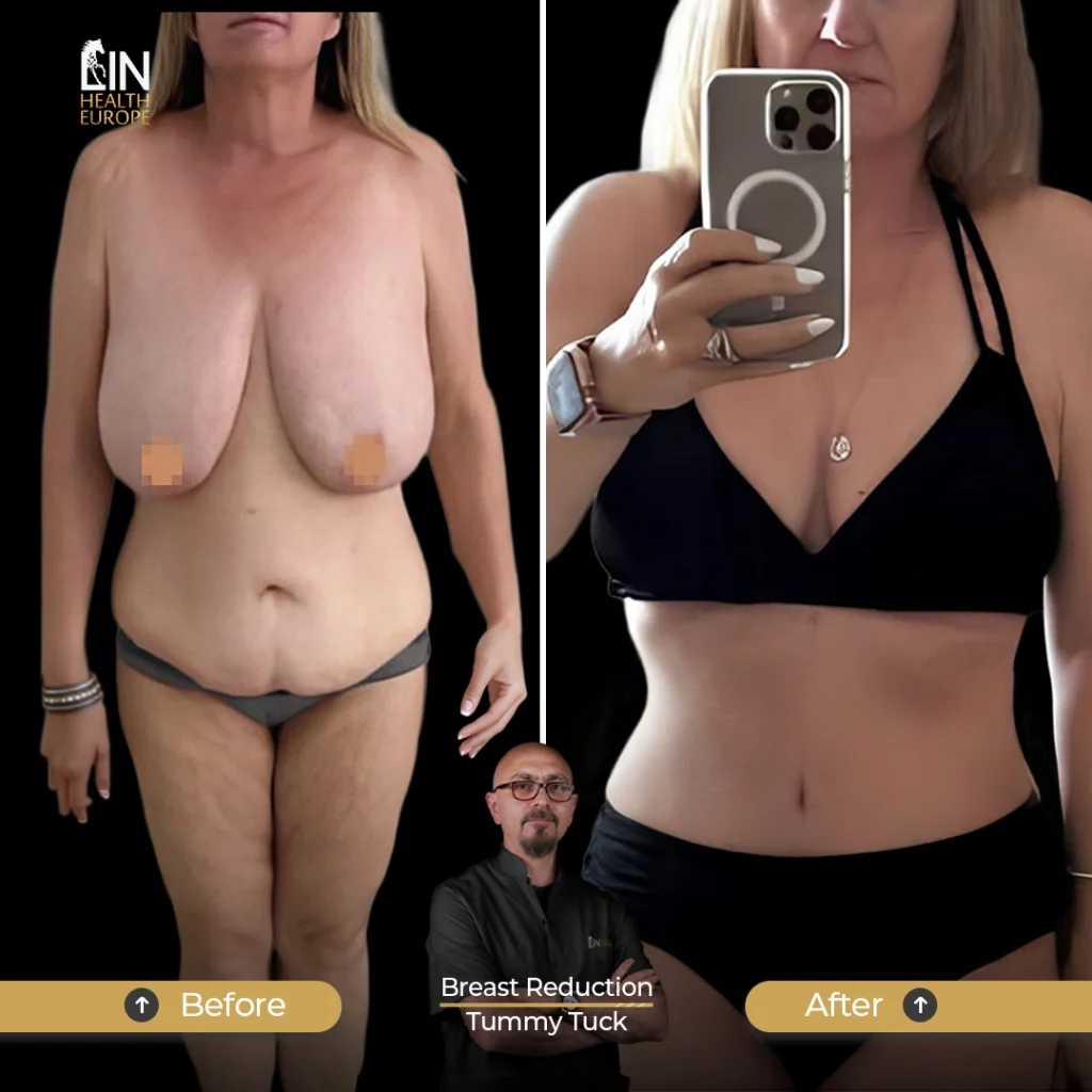 BR-Tummy Tuck-2