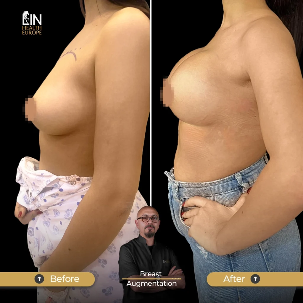 Breast-A-1