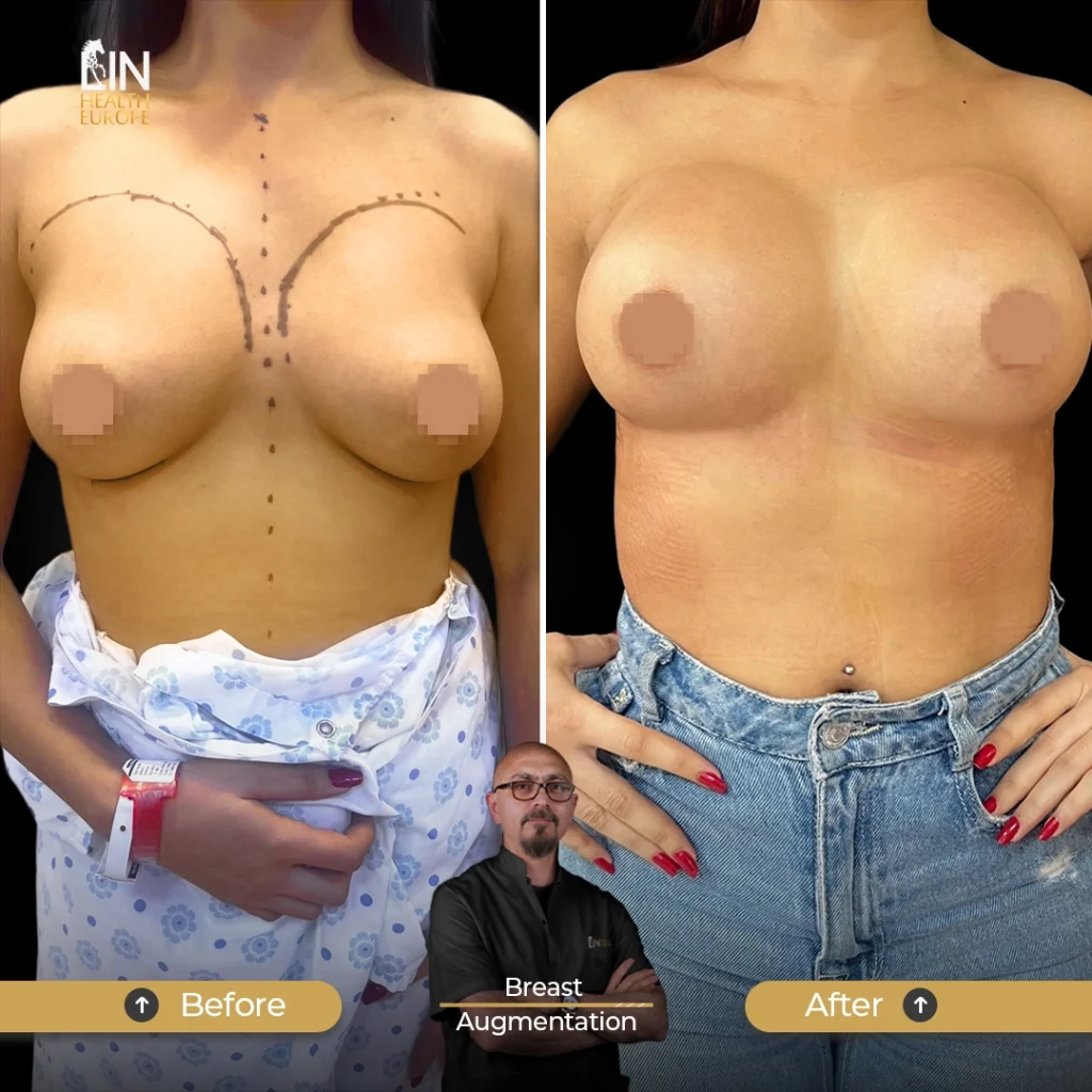 Breast-A-2